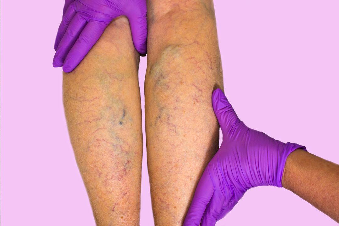 varices dans les jambes