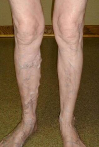 Varices