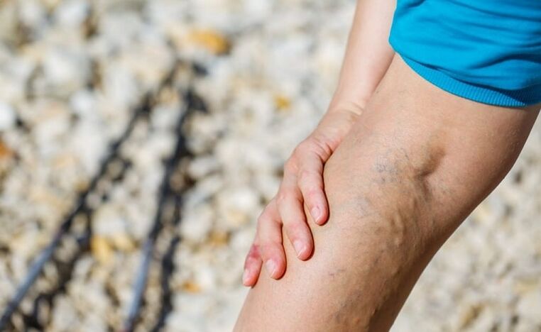 Varices dans la jambe